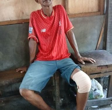 Tak Punya BPJS, Penarik Becak di Medan Enam Bulan Menderita Patah Lutut